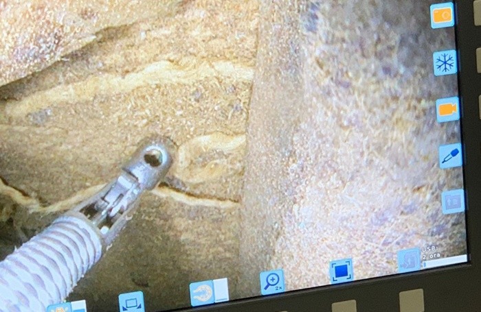 L'endoscopio Storz in azione