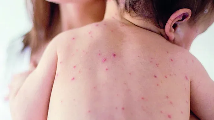 Mässling och infektionsfall ökar: vaccination är nödvändigt.”