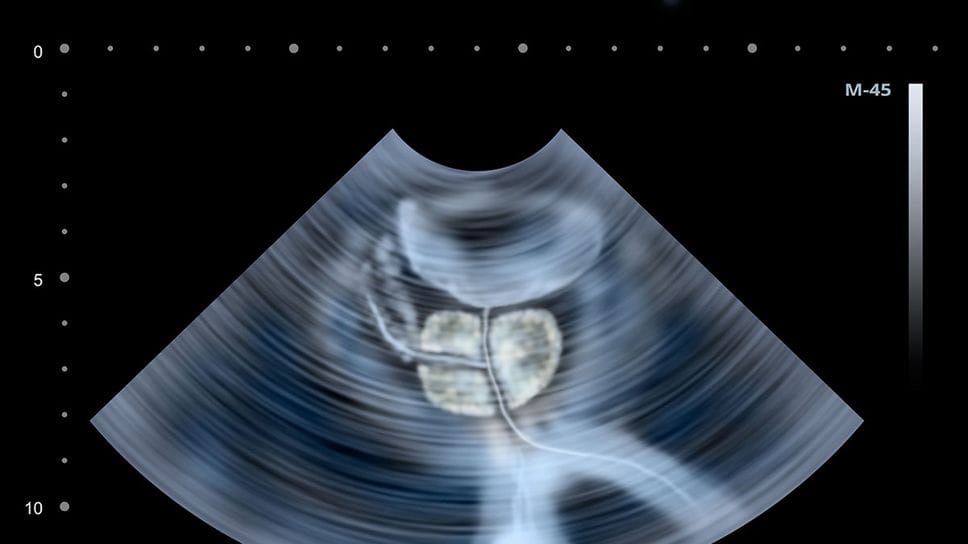Ecografia alla prostata