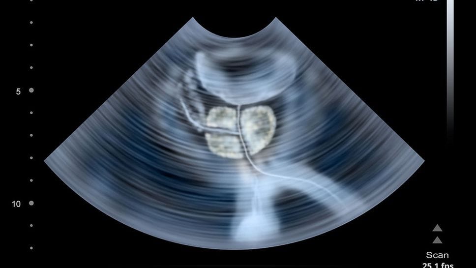 Ecografia transrettale alla prostata