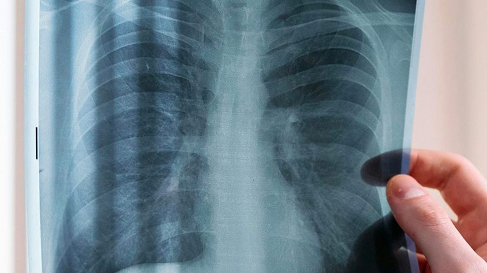 La «FPP» può manifestarsi come complicanza di malattie autoimmuni e reumatologiche:  per questo scendono in campo due specialisti