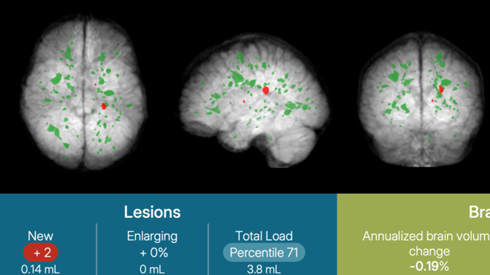 Istantanea di un esempio di report icobrain ms con la rappresentazione delle lesioni segmentate e la quantificazione dei volumi lesionati e del volume cerebrale