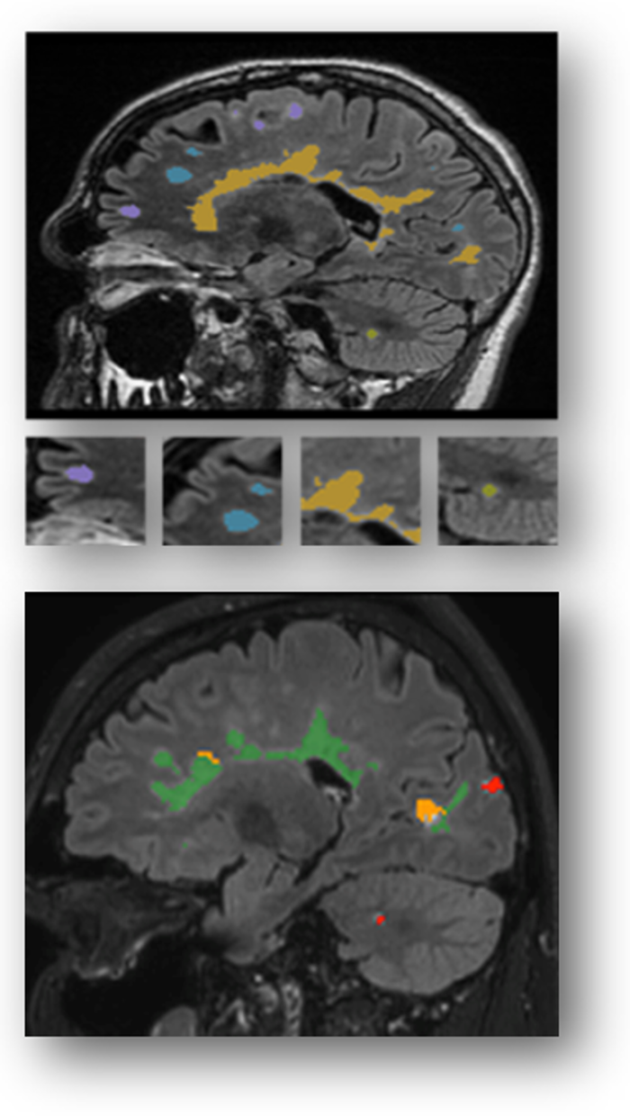 Esempi di lesioni FLAIR segmentate, codificate a colori in base alla loro localizzazione (in alto) e alla loro evoluzione nel tempo (in basso).