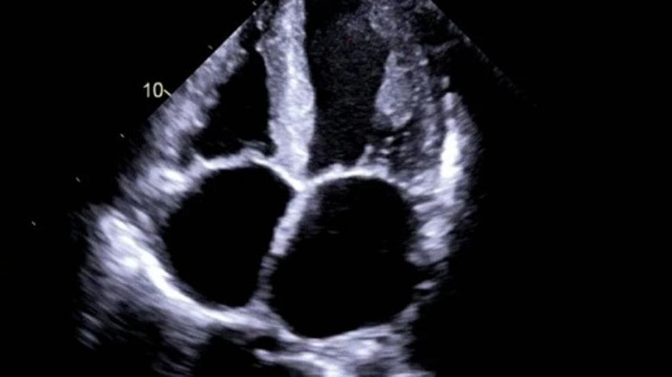 La diagnosi di amiloidosi cardiaca è impensabile senza l’imaging cardiaco