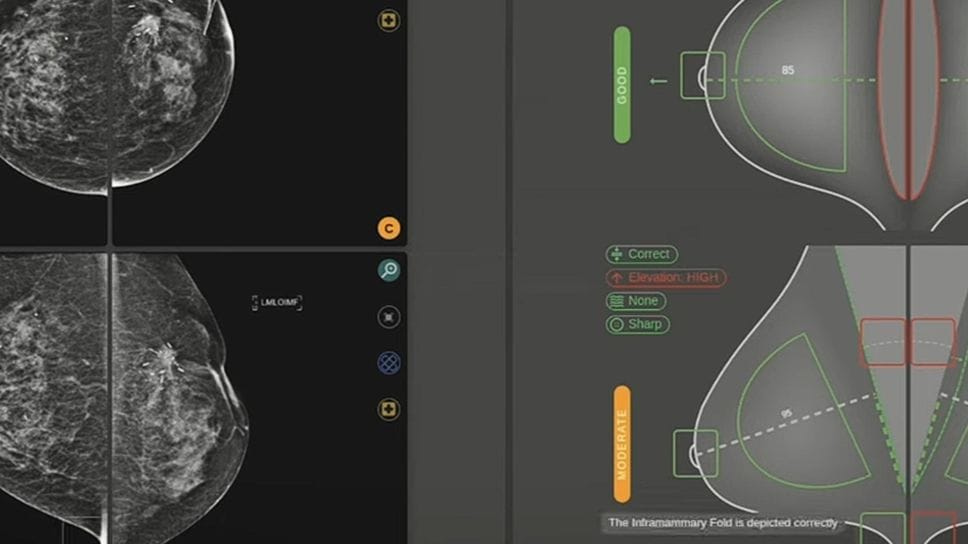 L’applicazione dell’IA nella diagnosi di tumore al seno