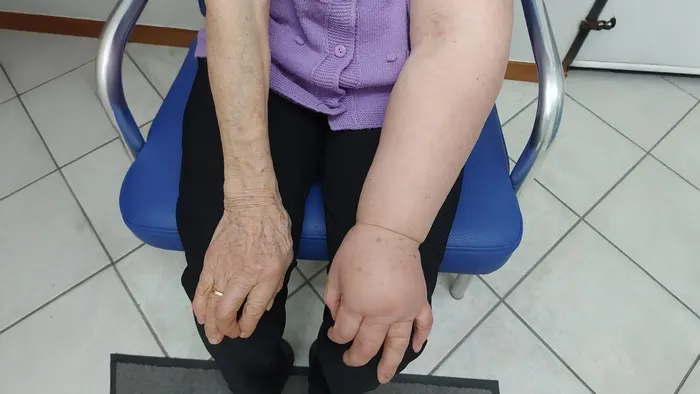 https://storage.ecodibergamo.it/media/photologue/2025/7/27/photos/cache/quando-il-corpo-non-drena-piu-cose-il-linfedema-e-perche-va-trattato-con-un-ap_6529435e-689d-11f0-8888-5640fb62cdf0_1920_1080_v3_large_16_9.webp