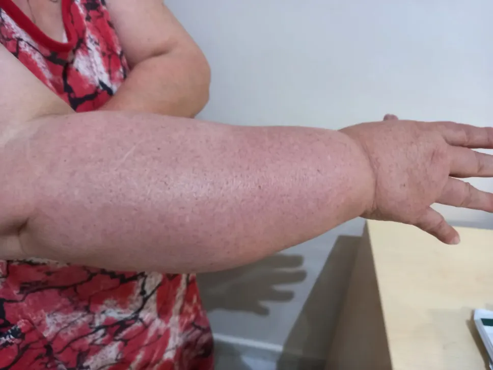 Il linfedema non è un semplice problema estetico, ma una vera e propria malattia cronica