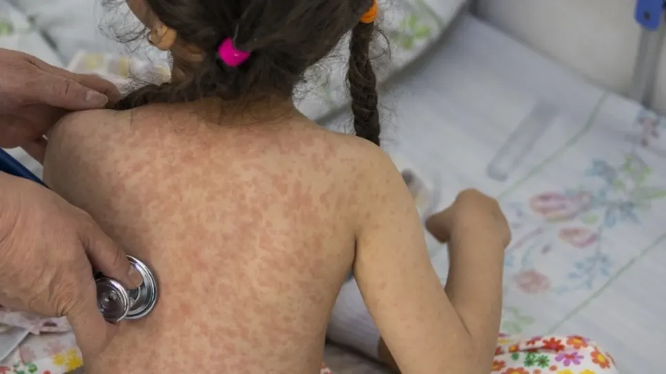 Un medico visita una bimba colpita dal morbillo Un medico visita una bimba colpita dal morbillo