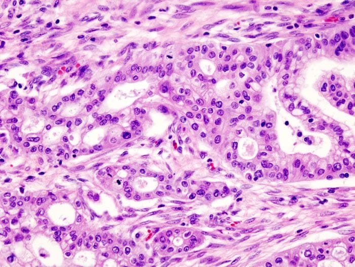 Le cellule del tumore del pancreas si travestono per sfuggire ai farmaci 