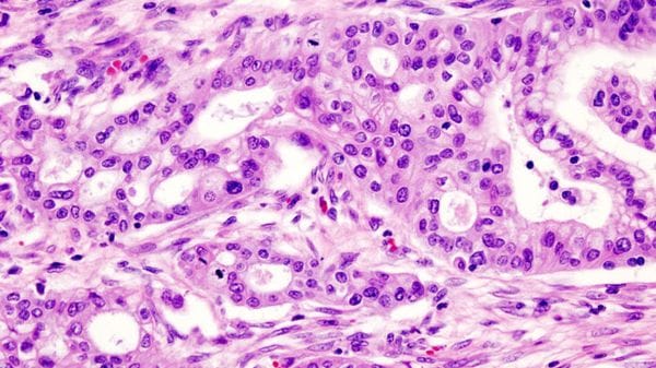 Le cellule del tumore del pancreas si travestono per sfuggire ai farmaci 