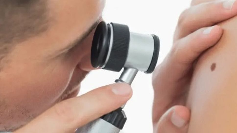 Il vaccino a mRNA contro il melanoma abbatte le metastasi