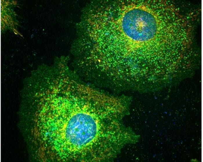 Le cellule tumorali diventano zombie per sfuggire alla chemioterapia 