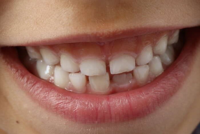 Il sorriso è modellato da rare varianti di un gene 
