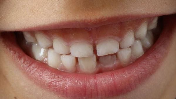 Il sorriso è modellato da rare varianti di un gene 