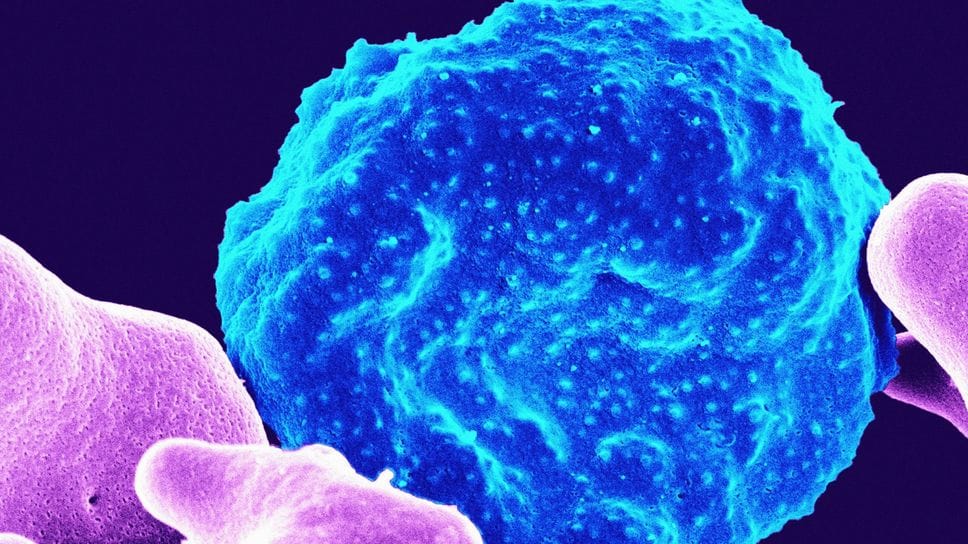 Il tumore alla prostata è un «killer silenzioso»: tenere controllato il «Psa» aiuta a prevenirlo