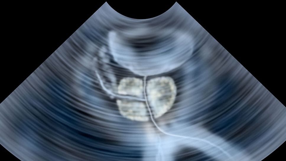 Ecografia alla prostata