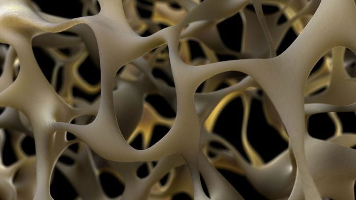 Osteoporosi, malattia silenziosa delle ossa: ecco come curarla