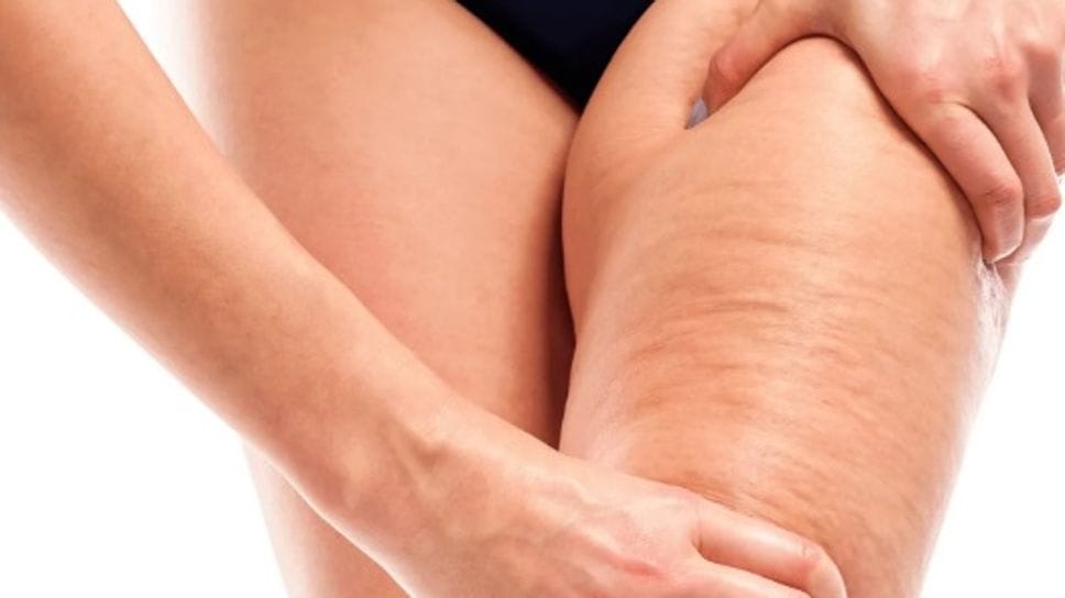 Su linfedema e lipedema intervenire ai primi segnali