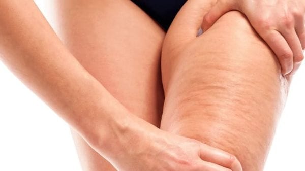 Su linfedema e lipedema intervenire ai primi segnali