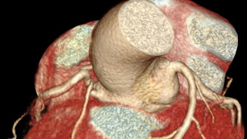 Il cuore visto attraverso una Tac Cardiaca