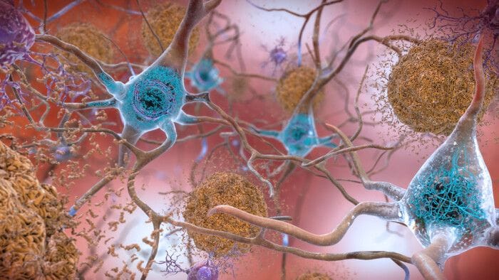 La proteina chiave dell'Alzheimer si propaga attraverso i neuroni