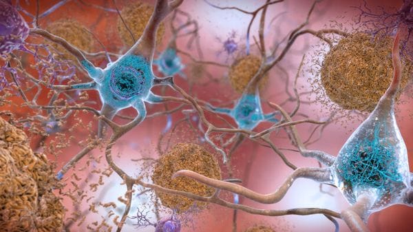 La proteina chiave dell'Alzheimer si propaga attraverso i neuroni