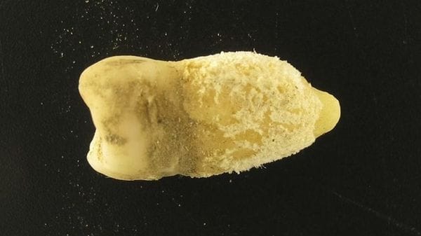 La scarlattina circolava in Sudamerica prima di Colombo