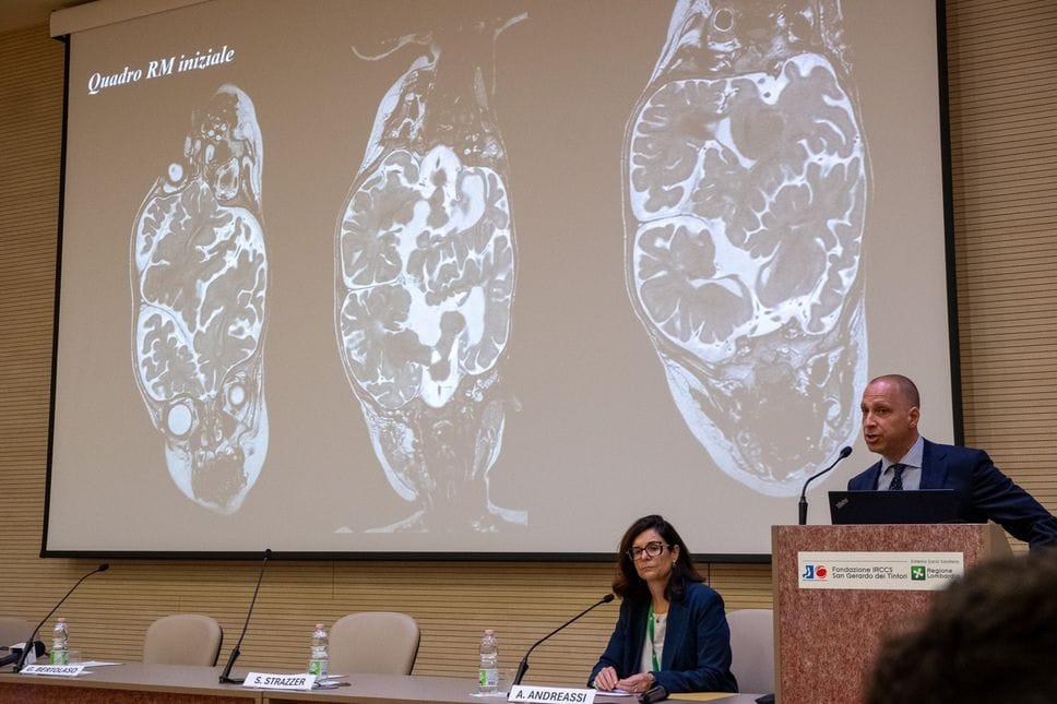 Intervento di 40 ore per separare gemelle siamesi al San Gerardo. Nello studio anche medici del «Papa Giovanni»