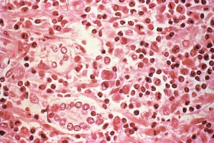 Prima sequenza genetica dell'hantavirus Andes, identica per il 99% rispetto al 2018