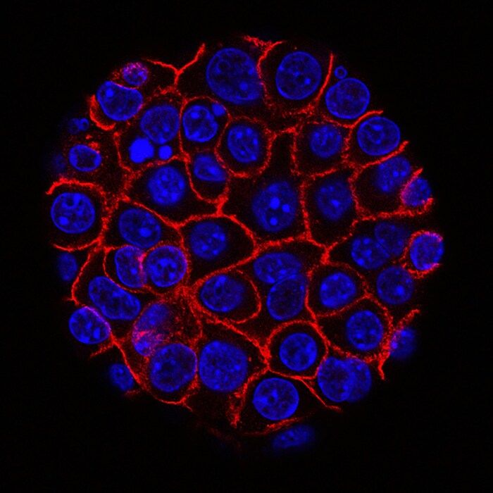 Tumore al pancreas, trovata la proteina che lo rende resistente ai farmaci