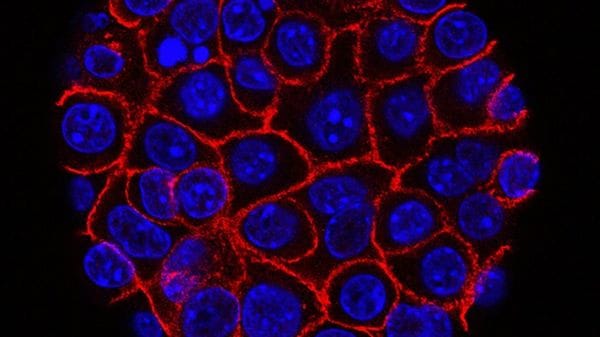 Tumore al pancreas, trovata la proteina che lo rende resistente ai farmaci