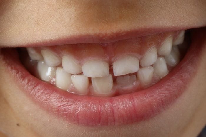  L'inquinamento da metalli è dannoso per i bambini, lo dicono i denti da latte 