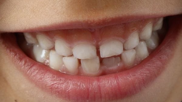  L'inquinamento da metalli è dannoso per i bambini, lo dicono i denti da latte 