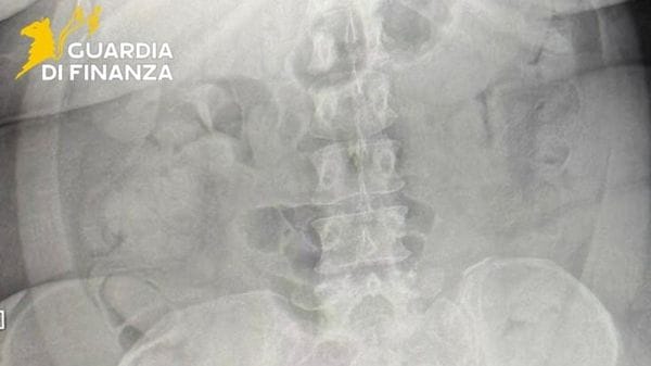 In aeroporto a Orio con 74 ovuli di droga nello stomaco: arrestata 44enne