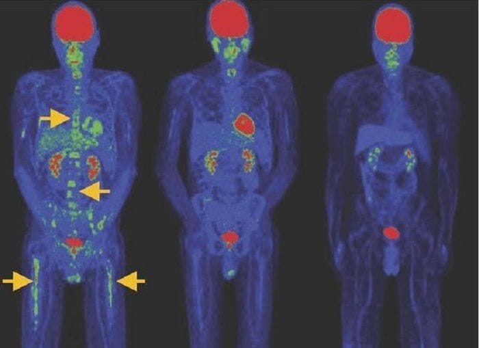 Tumori del sangue, nuova terapia Car T dà remissione a basse dosi