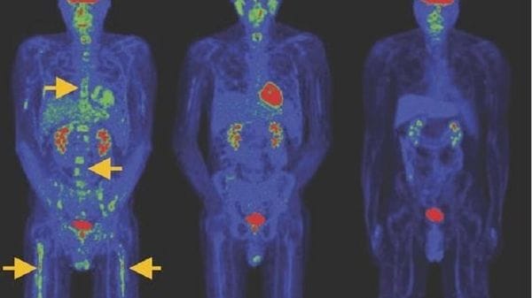 Tumori del sangue, nuova terapia Car T dà remissione a basse dosi