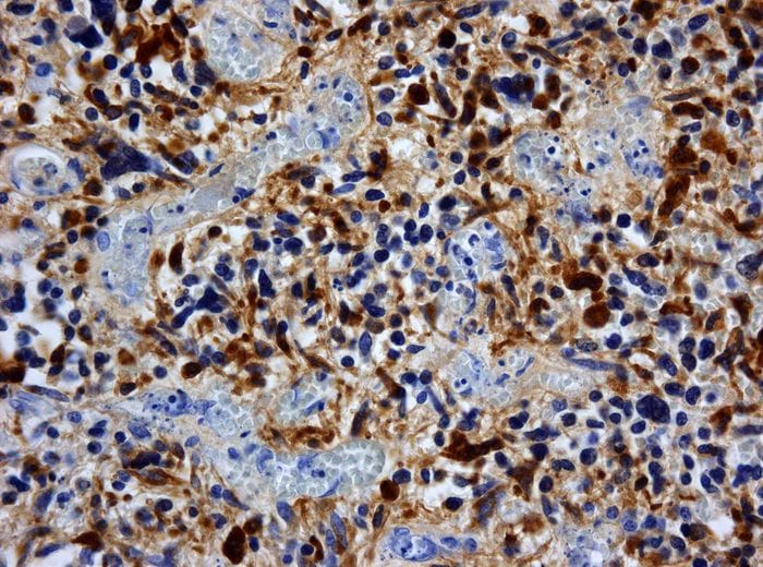 Allo studio un vaccino personalizzato contro il glioblastoma