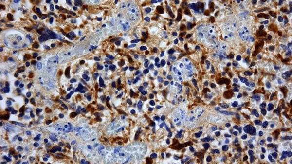 Allo studio un vaccino personalizzato contro il glioblastoma