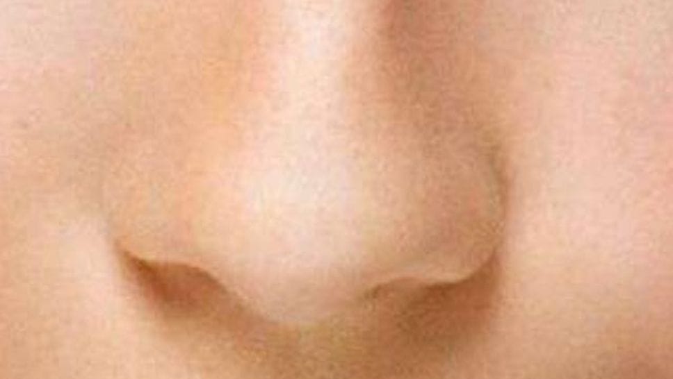 Naso, la rinoplastica non è solamente una soluzione estetica