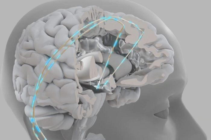 Chip impiantabili più vicini, aiutano a parlare e a camminare   VIDEO