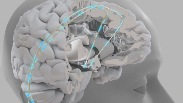 Chip impiantabili più vicini, aiutano a parlare e a camminare   VIDEO