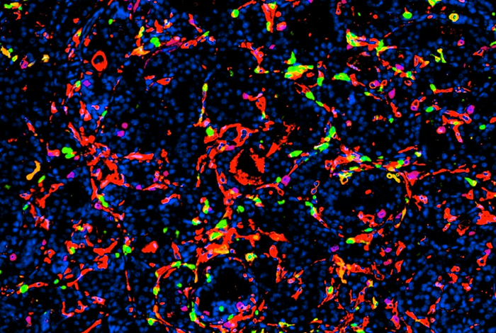 Nanoparticelle efficaci contro il tumore della prostata, uccidono le cellule