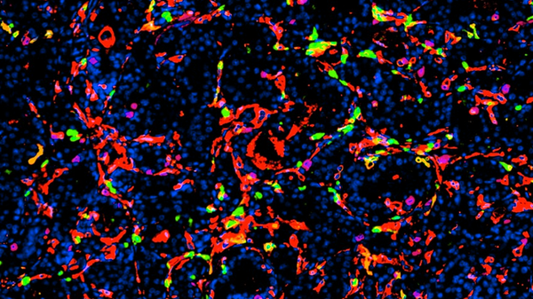 Nanoparticelle efficaci contro il tumore della prostata, uccidono le cellule