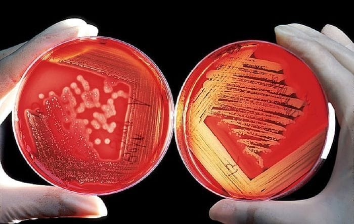 Una malattia autoimmune in remissione da 15 anni, grazie alle staminali 