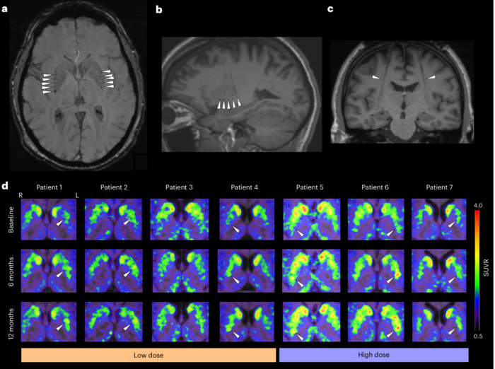 Parkinson, trapianto di staminali nel cervello di 8 pazienti 