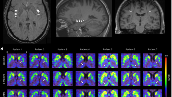 Parkinson, trapianto di staminali nel cervello di 8 pazienti 
