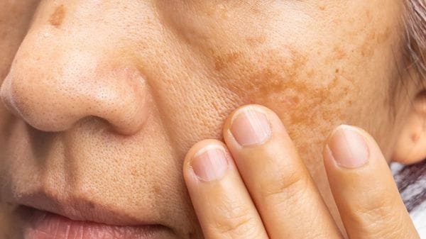 Macchie solari, come proteggersi e quando affidarsi al laser