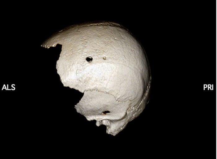 Quattro interventi al cranio, scoperto un raro caso di chirurgia medievale