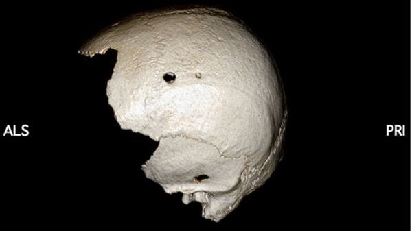 Quattro interventi al cranio, scoperto un raro caso di chirurgia medievale