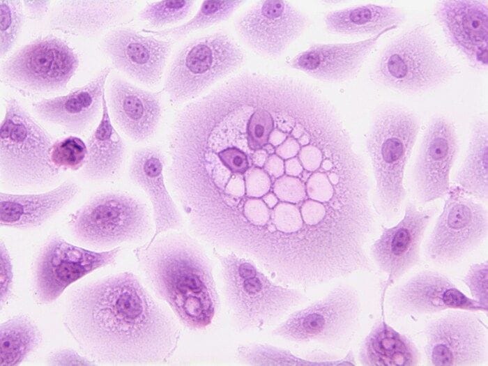 Cellule che si muovono in gruppo punto debole del tumore al seno 